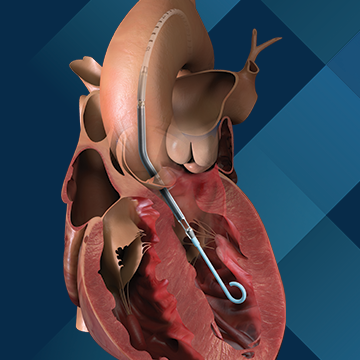 Cardiologia, al G.B. Grassi di Ostia nel cuore malato si monta il turbo 2