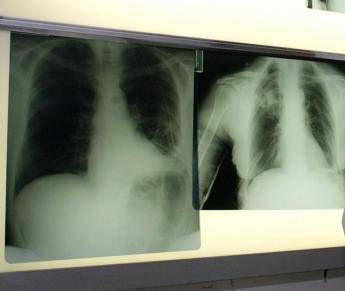 Bpco, ok dell’Ema alla prima terapia con propellente green