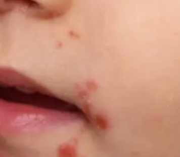 ASL-ROMA6-DERMATITE-ATOPICA-VACCINAZIONE-