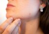 Screening dermatologico gratuito a Cerveteri: data, orari e come accedere