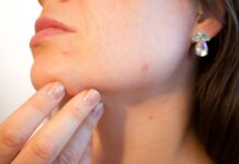 Screening dermatologico gratuito a Cerveteri: data, orari e come accedere