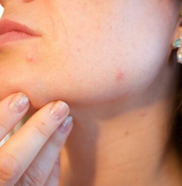 Screening dermatologico gratuito a Cerveteri: data, orari e come accedere