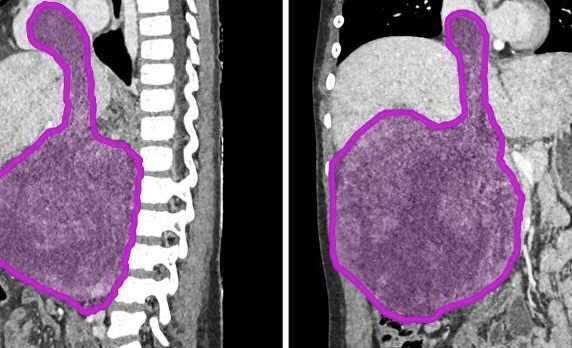 Un miracolo di chirurgia pediatrica: asportato tumore gigante dal cuore di una bimba di 8 anni 1