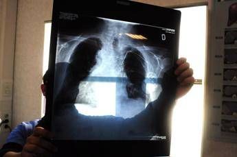 Tumore al polmone, con terapia mirata più chemio sopravvivenza globale di quasi 4 anni