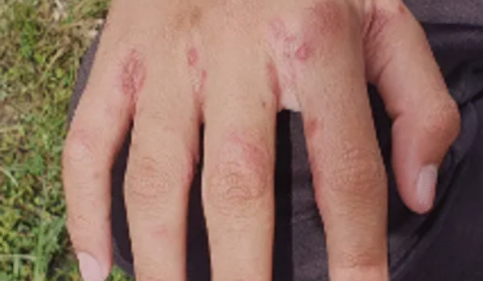 SCABBIA IMMAGINE PARTE CORPO MANO CONTAGIATA DA PIXABAY IMMAGINE FREE