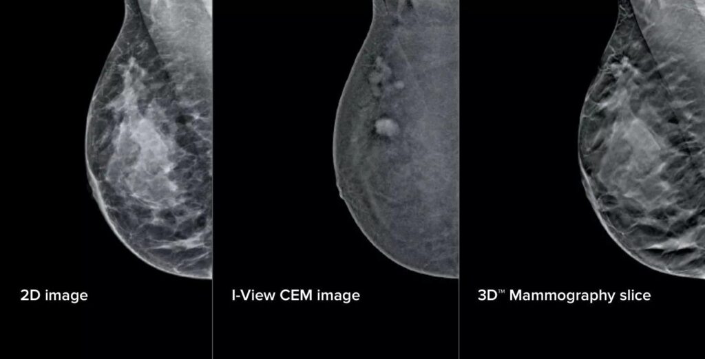 Tumore al seno, al San Camillo la mammografia diventa “intelligente”: l’IA al servizio della prevenzione 1 Tumore al seno, al San Camillo la mammografia diventa “intelligente”: l’IA al servizio della prevenzione 1