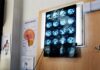 Di Battista, cosa indica un mal di testa forte e improvviso: le ipotesi del neurologo