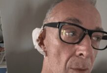 Linus ha una malattia della pelle: “Si chiama Epitelioma”. Di cosa si tratta