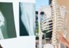 Osteoporosi, esami gratuiti nella Asl Roma 6: data, orari, come e dove farli