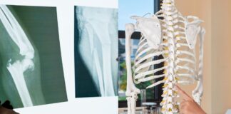 Osteoporosi, esami gratuiti nella Asl Roma 6: data, orari, come e dove farli