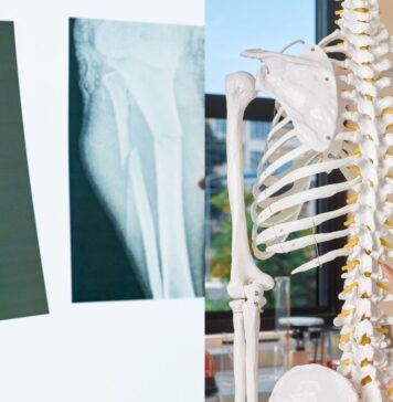 Osteoporosi, esami gratuiti nella Asl Roma 6: data, orari, come e dove farli