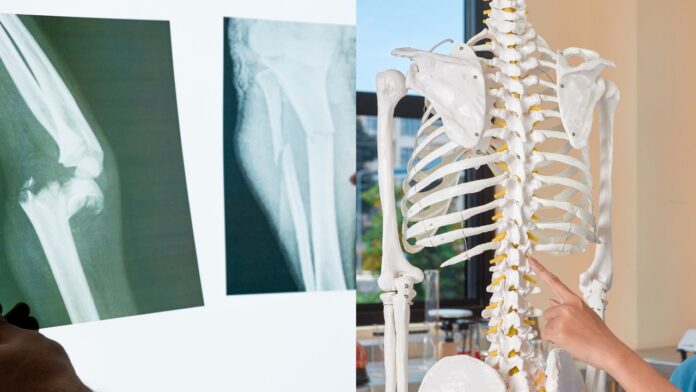 Osteoporosi, esami gratuiti nella Asl Roma 6: data, orari, come e dove farli