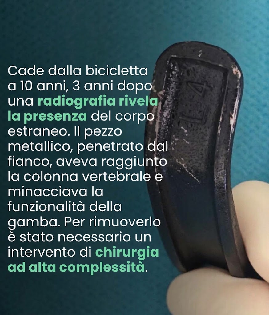 Freno nella schiena per 3 anni dopo la caduta in bici: operato 13enne al Bambino Gesù (VIDEO) 1